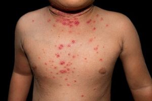 molusco-contagioso-pediatrics-lleida
