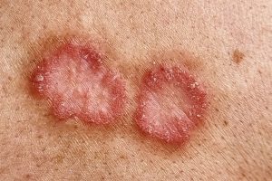 Ringworm (Tinea Corporis) on a human back, is a circular-shaped skin rash caused by a fungal infection, Dermatophytosis